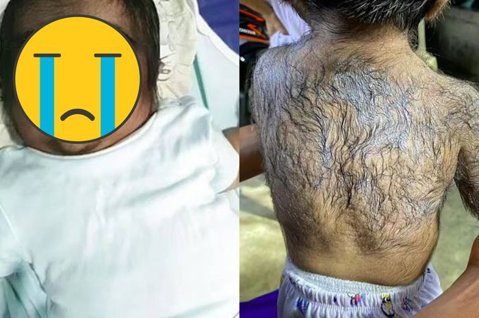 Kolase foto bayi laki-laki dari Filipina lahir dengan kondisi mengidap Sindrom Manusia Serigala atau Hipertrikosis.
