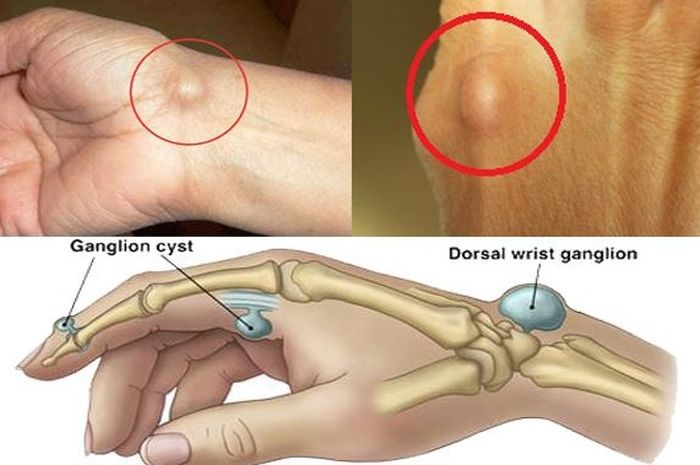 Ada Benjolan Di Tangan Jangan Anggap Sepele Bisa Jadi Tanda Penyakit Serius