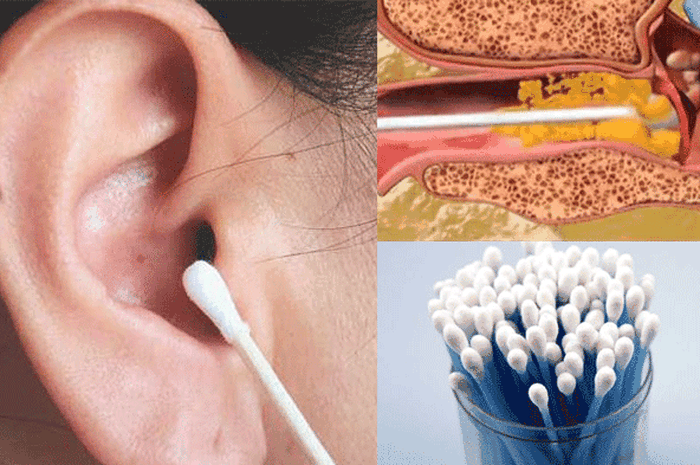 Telinga Sering Gatal Jangan Gunakan Cotton Buds Untuk Bersihkan Telinga Lagi Efeknya Ternyata Fatal Loh