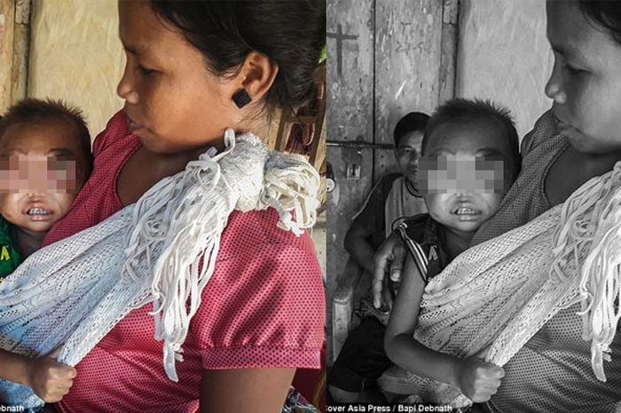 Perjuangan Balita dengan Penyakit Langka di Bojonegoro, Dua Tahun Menunggu Operasi