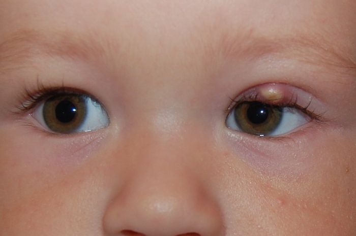 Cara Mengobati Bintitan Pada Mata Anak Terkait Mata