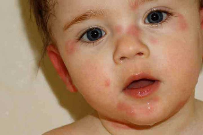 Ini Gejala Alergi Yang Pasti Terjadi Pada Anak - Nakita