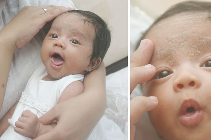 Cara Menghilangkan Kerak Di Kepala Bayi Hindari Memijat Ubun Ubun