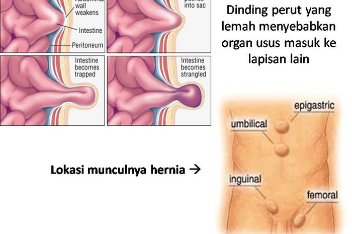 Se puede morir de una hernia