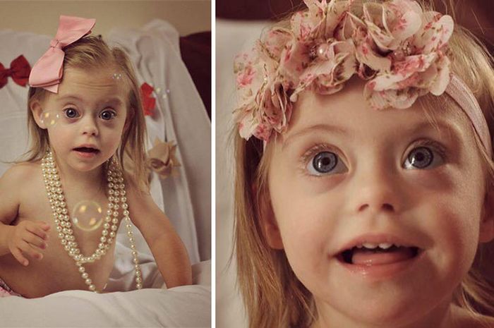 bayi: Ciri Bayi Down Syndrome Ringan