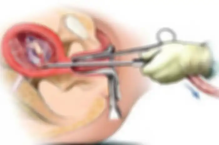 Kuret dalam bahasa medis dikenal dengan nama D&C (dilation and curettage), dalam Bahasa Indonesia disebut dengan dilasi dan kuretase.
