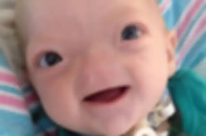 Eli Thompson Finch adalah bayi yang lahir tanpa organ hidung memiliki kisah hidup penuh perjuangan yang menginspirasi.