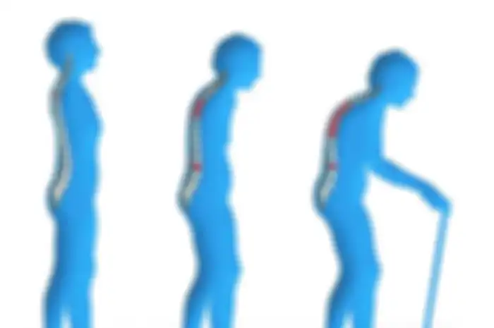 Kesehatan tulang perlu dijaga agar tidak mengalami osteoporosis di masa mendatang. Ada beberapa kebiasaan yang bisa mengakibatkan osteoporosis.