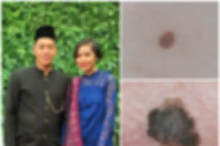 Kanker melanoma merupakan salah satu jenis kanker kulit yang terbilang langka, namun juga sangat berbahaya.