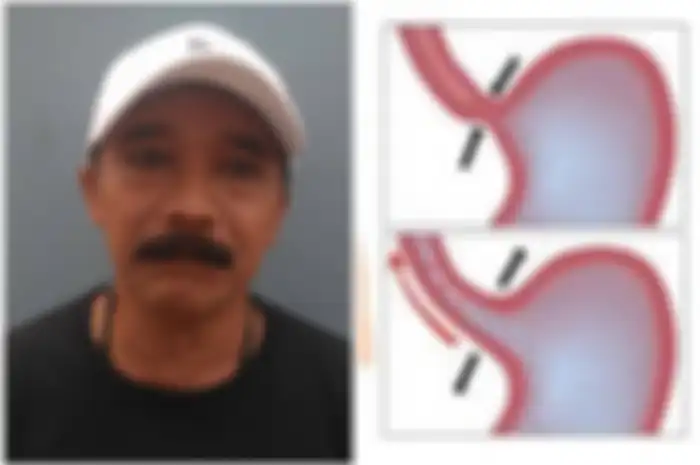 Gangguan lambung bisa dibagi secara sederhana menjadi gangguan lambung organik dan gangguan lambung fungsional.