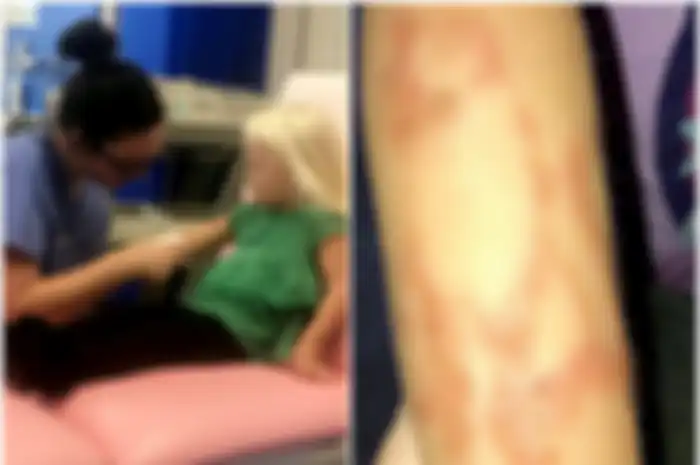 Seorang ibu telah memperingatkan orang tentang bahaya tato henna setelah putrinya dibiarkan dengan luka bakar kimia yang mengerikan.