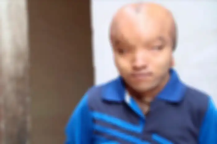 Seorang pria dengan kondisi fisik berbeda yang di juluki dengan Alien ini salah satu kasus langka. yang belum diketahui penyebabnya.
