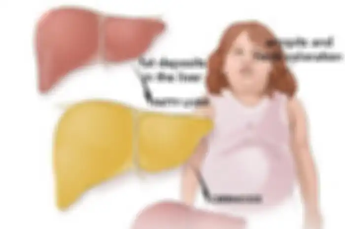 Hal itu terjadi ketika timbunan lemak menumpuk di sekitar organ, memengaruhi fungsi dasarnya dan menyebabkan peradangan.