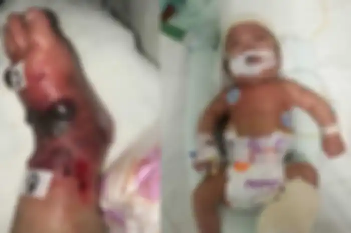 Kaki seorang bayi 4 bulan menjadi bengkak setelah jalani transfusi darah, tapi dokter maupun perawat tak ada yang mau mengaku salah.
