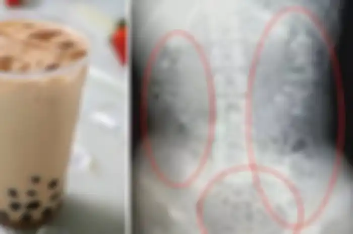 Seorang remaja dari provinsi Zhejiang China, dikirim ke rumah sakit karena mengalami sembelit selama 5 hari setelah mengonsumsi bubble tea.