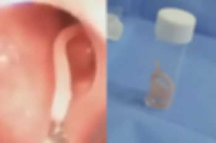 Kondisi ini disebabkan oleh sanitasi yang buruk, yang tidak diperhatikan dalam sebagian besar kasus, terutama jika jumlah cacing kecil.