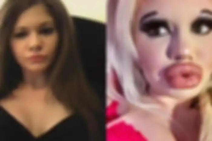 Niat mahasiswi ini ingin lebih cantik, bahkan mirip boneka barbie, ia pun melakukan operasi plastik hingga 15 kali. Tapi, hasilnya malahan seperti ini.