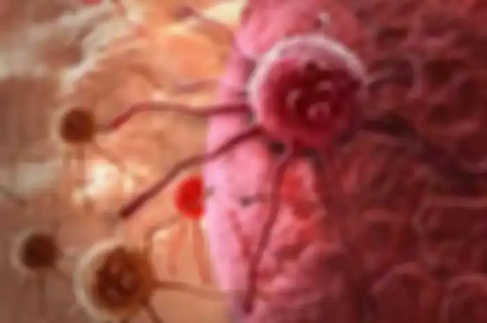 Secara pasti obat kanker memang belum ditemukan, pasalnya perawatan bagi penderita kanker meliputi radiasi, operasi, kemoterapi, ataupun transplantasi