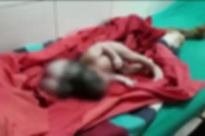 Seorang wanita melahirkan bayi perempuan dengan kelainan medis membuatnya ia seolah memiliki tiga kepala.