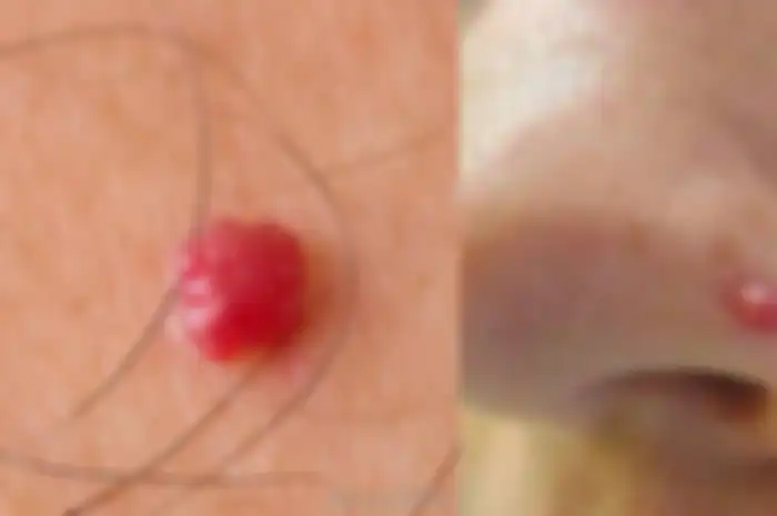 Angioma adalah tumor jinak pembuluh darah yang seperti tahi lalat berwarna merah. Ini yang perlu kalian ketahui.