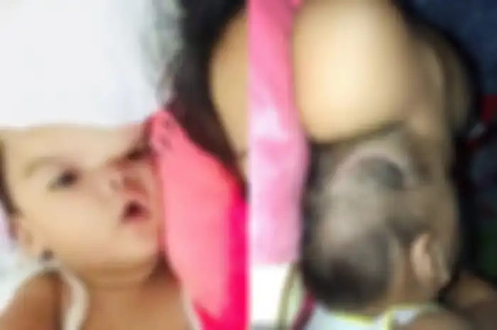 Keluarga seorang bayi perempuan berusaha mati-matian menemukan ahli bedah untuk menghilangkan benjolan yang disebut seperti balon pada kepala anaknya.
