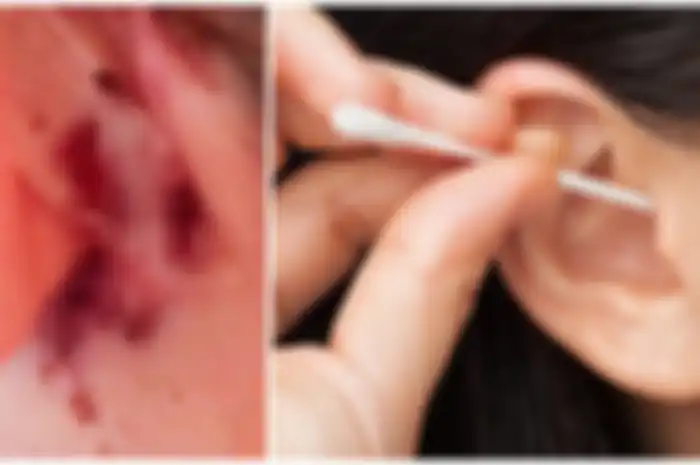 Seorang wanita asal Australia telah membagikan pengalaman mengerikannya bersinggungan dengan infesi otak karena pemakaian cotton bud.