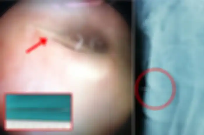 Organ intim anak laki-laki tersebut berpotensi cedera, menurut scan x-ray menunjukkan benda tajam tersebut menancam sekitar 5cm.