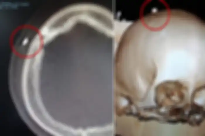 Setelah 12 hari, scan akhirnya mengungkap ada benda asing yang bersarang di tengkoraknya. Bagaimana kisah selengkapnya?