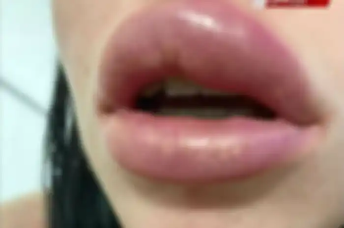 Namun, perlu diketahui pula ada risiko yang bisa terjadi dari suntik filler bibir, apalagi jika prosedur yang dilakukan tak tepat.