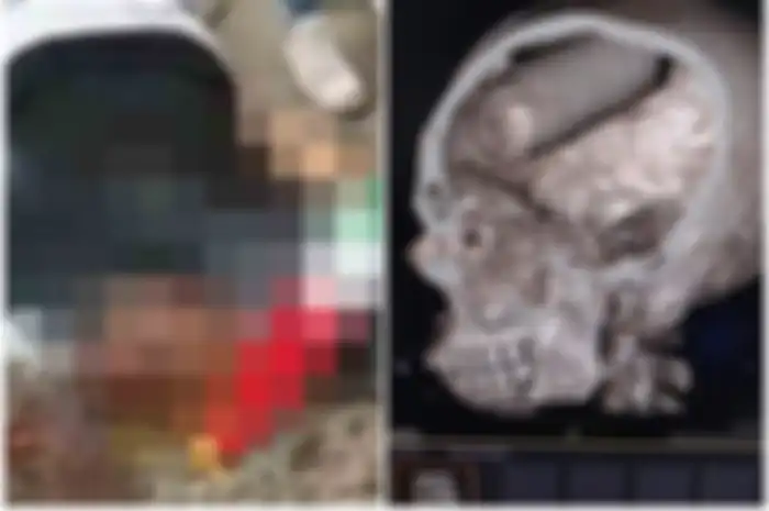 Sebuah hasil X-ray menunjukkan sebuah tabung gas bersarang di kepala demonstran yang tewas dalam aksi unjuk rasa.