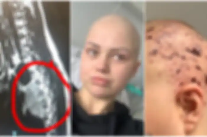 Seorang ibu awalnya menderita nyeri panggul didiagnosis mengidap kanker langka yang biasanya ditemukan pada anak-anak usia di bawah lima tahun.
