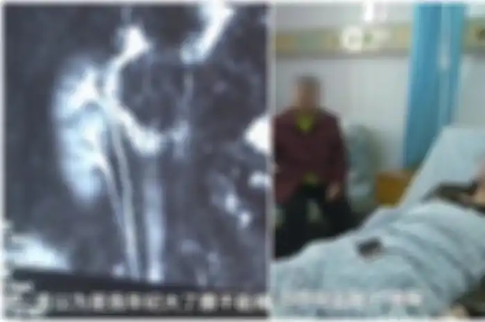 Dia mengalami sakit punggung, dan setelah resonansi magnetik, dokter menemukan kejanggalan pada ginjal Li.