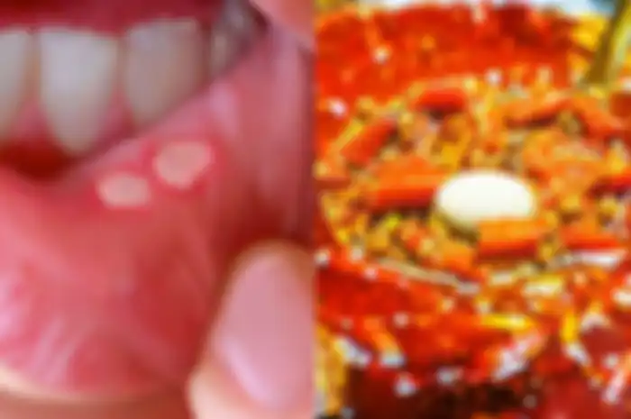 Anda mungkin tidak menyadari bahwa sariawan yang Anda rasakan itu juga berasal dari makanan sehari-hari yang masuk ke tubuh Anda.