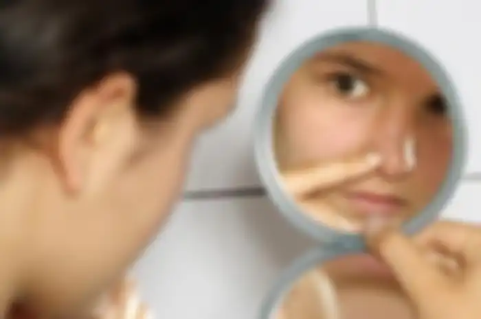 Inilah Penyebab Jerawat