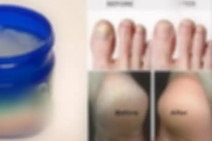 Obat ini populer digunakan banyak orang untuk mengobati batuk dan pilek, ternyata tak banyak yang tahu ada kegunaan lainnya bagi masalah kita yang lain. 