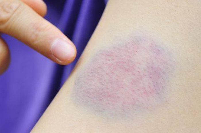Berikut gejala kanker darah yang sepele, namun sering diabaikan. Ketahui 5 gejala leukimia yang mungkin belum diketahui!