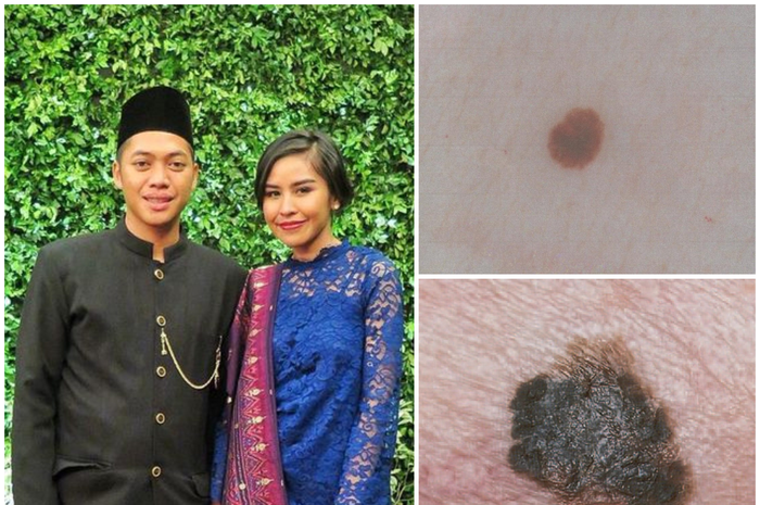 Kanker melanoma merupakan salah satu jenis kanker kulit yang terbilang langka, namun juga sangat berbahaya.