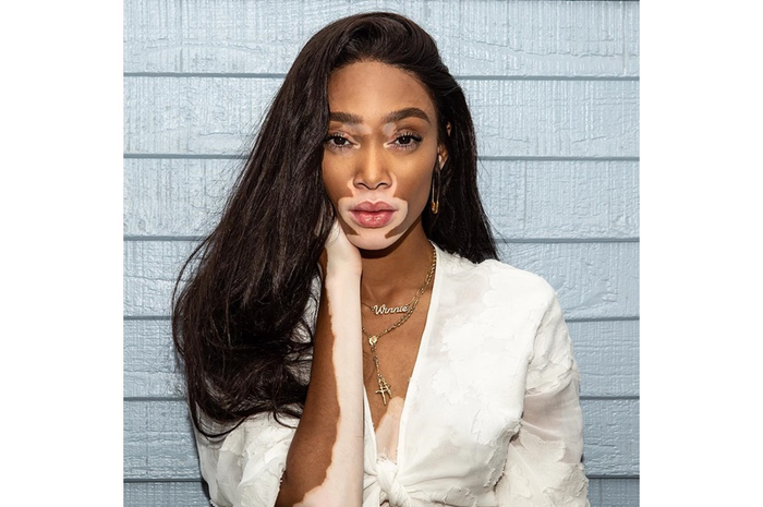 Winnie Harlow memiliki vitiligo, sebuah kondisi langka yang membuat kulitnya tidak merata. Ada kulit bercak putih di antara kulitnya.