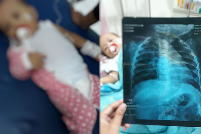 19.000 balita per tahun, membuat pneumonia mendapat predikat sebagai penyebab kematian bayi nomor satu di Indonesia.