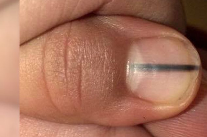Jika Anda mendapati gejala yang tidak biasa pada kulit Anda, seperti tiba-tiba ada tahi lalat, sebaiknya segera menghubungi dokter. 