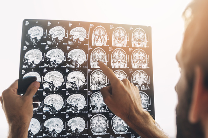 Tidak lagi menggunakan operasi konvesional, proses pengangkatan tumor otak sekarang bisa melalui alis saja!