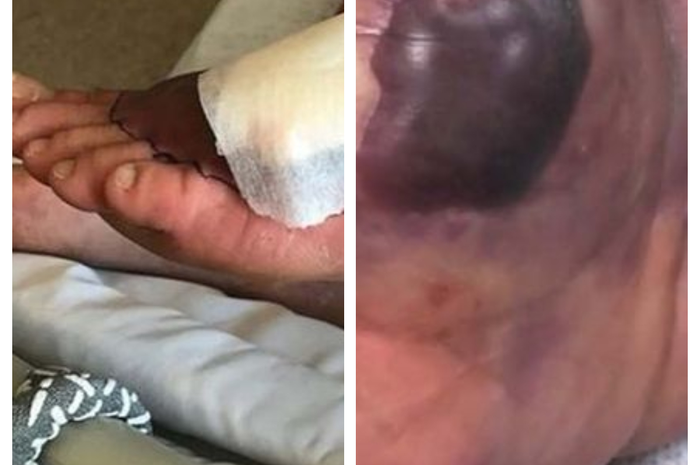kaki dan tangan seorang pria menjadi mengerikan, ia bahkan hampir kehilangan kakinya setelah terinfeksi bakteri pemakan daging.