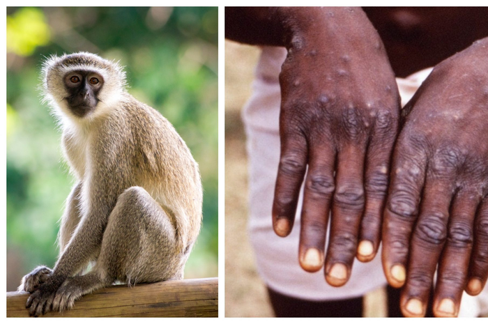 Organisasi Kesehatan Dunia (WHO) mengatakan monkeypox adalah virus mematikan yang berasal dari hujan tropis di Afrika Tengah dan Barat.