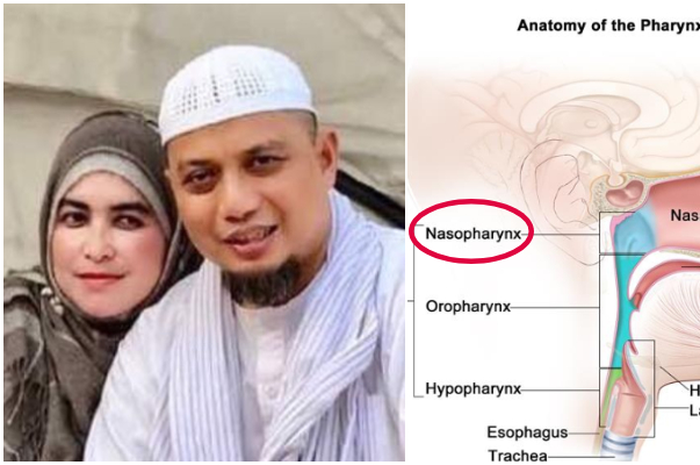Kita wajib meningkatkan kewaspadaan bila sudah mengalami mimisan. Sebab bisa jadi tanda kanker nasofaring seperti yang dialami ustad arifin ilham.
