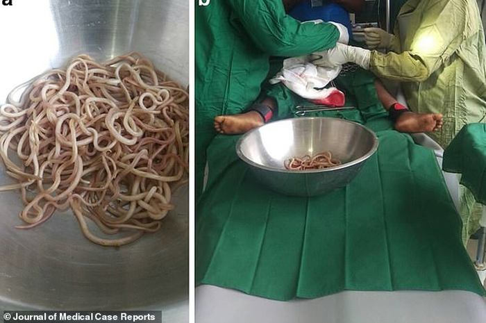 Menurut keterangan, dokter mengungkapkan bahwa bocah tersebut dirawat dan dioperasi karena infeksi yang mengancam jiwa.