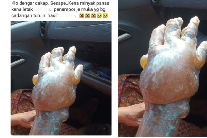 Kenyataanya hal itu justru berbahaya, luka bakar sebaiknya tidak pernah diobati dengan pasta gigi, minyak teripang, tepung, kecap, telur atau lainnya.