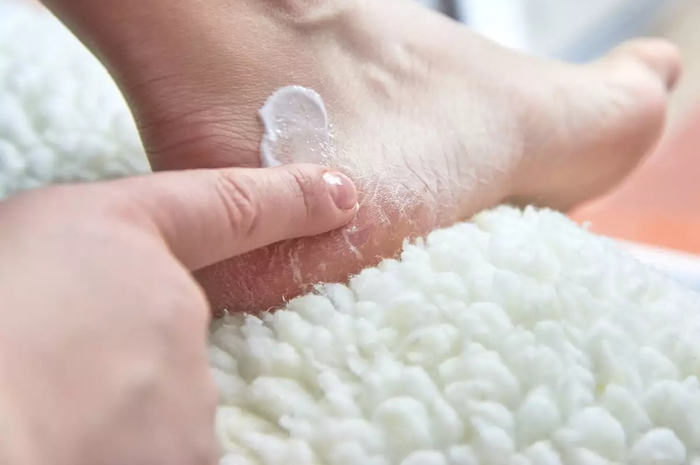 Begini cara menyembuhkan kaki pecah-pecah, cukup dengan baking soda dan bahan lainnya, tak perlu pakai salep. Ini dia, mau coba?