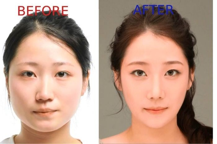 Operasi plasti yang paling terkenal dan sering dilakukan di Korea Selatan. Benarkah bikin para remaja ini semakin cantik?