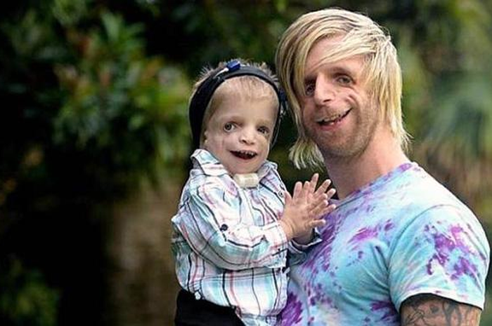 Jono Lancaster Jadi Sosok Inspiratif Berkat Wajahnya yang Buruk Rupa Akibat  Sindrom Treacher Collins