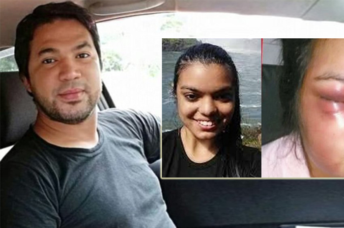 Dipukuli suaminya, mulut wanita malang ini robek dan kulitnya menghitam merah karena siksaan. Dia sampai harus melakukan operasi rekontruksi wajah agar normal lagi.